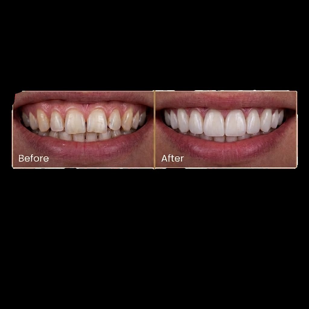 Porcelain dental veneers for a natural smile